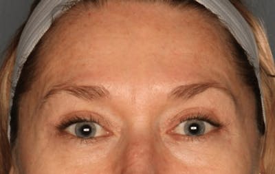 Blepharoplasty Before & After Gallery - Patient 55475010 - Image 2