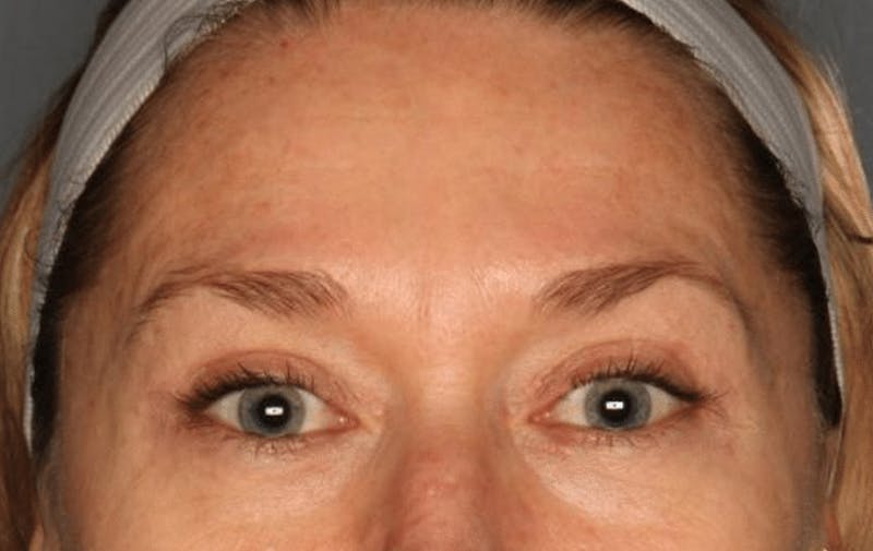 Blepharoplasty Before & After Gallery - Patient 55475010 - Image 2