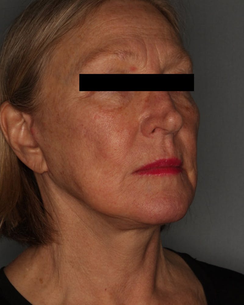 Facelift Before & After Gallery - Patient 55475009 - Image 4