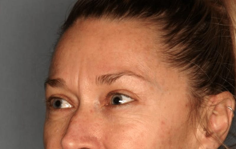Blepharoplasty Before & After Gallery - Patient 55475010 - Image 3