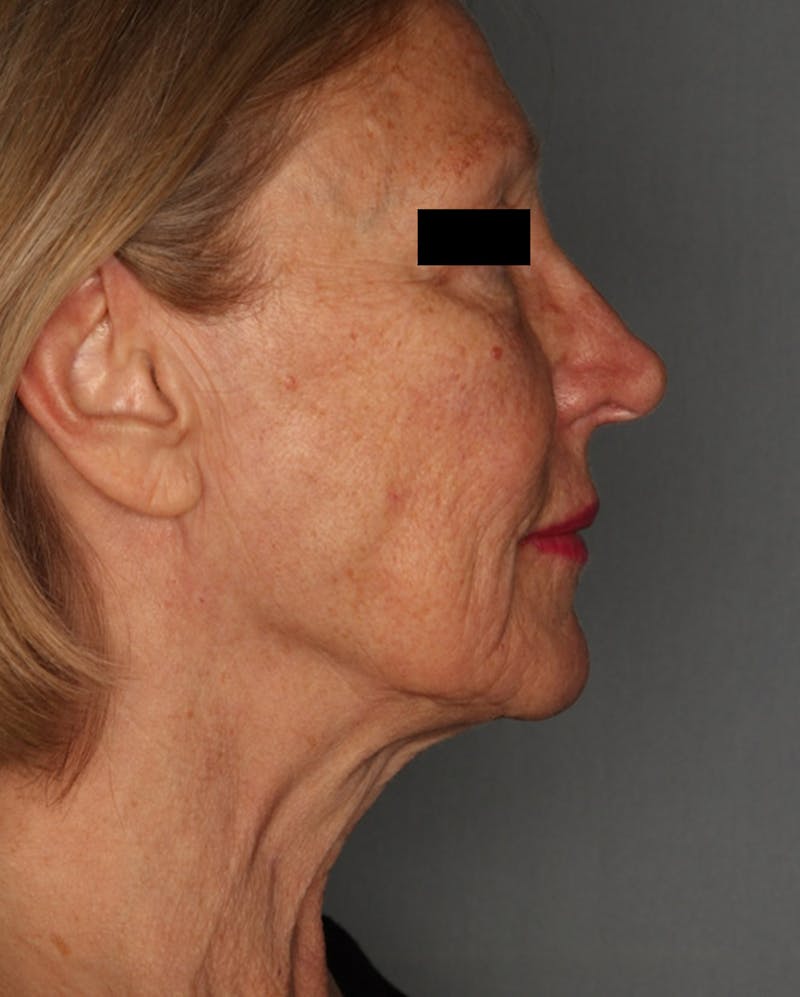 Facelift Before & After Gallery - Patient 55475009 - Image 5