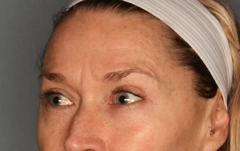 Blepharoplasty Before & After Gallery - Patient 55475010 - Image 4