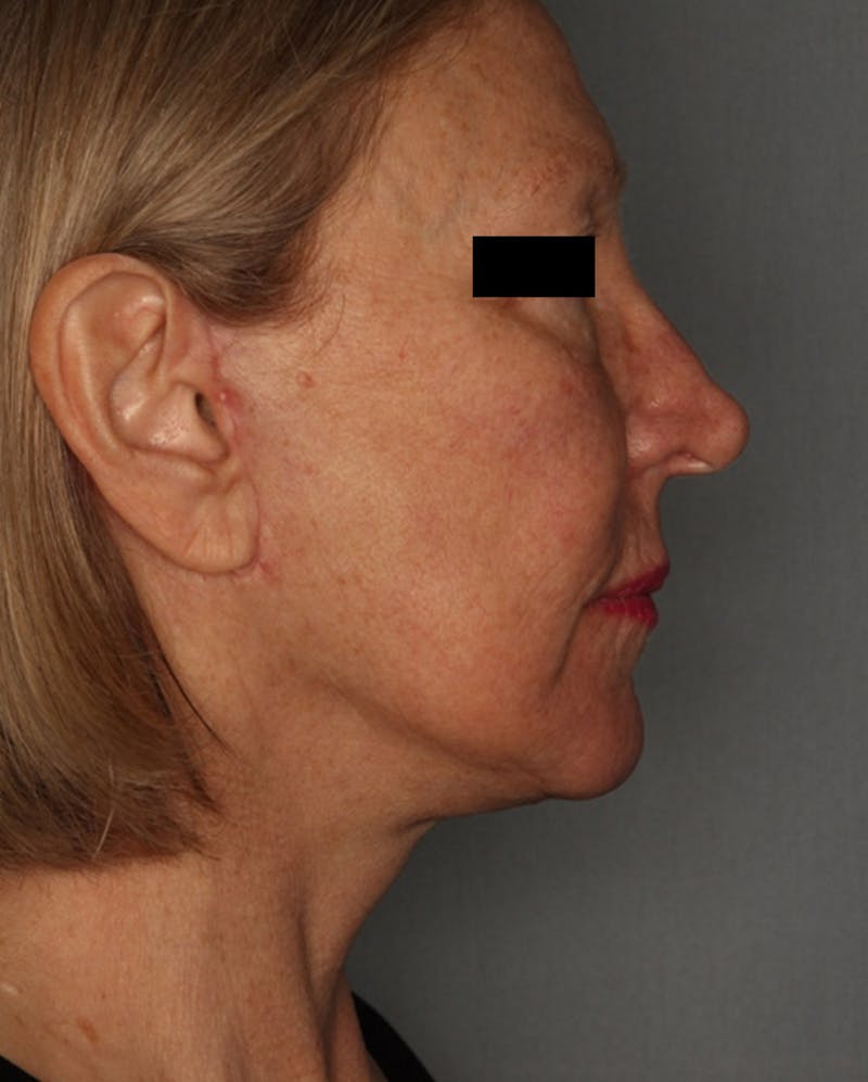 Facelift Before & After Gallery - Patient 55475009 - Image 6