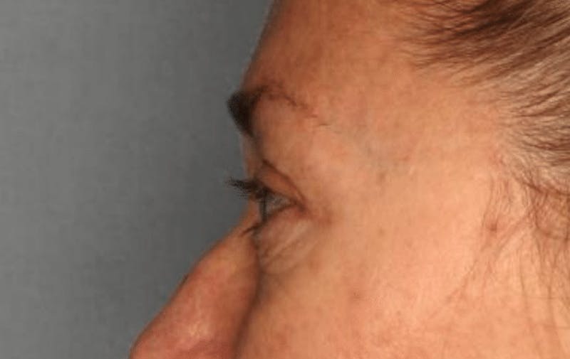 Blepharoplasty Before & After Gallery - Patient 55475010 - Image 5