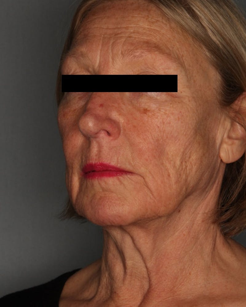 Facelift Before & After Gallery - Patient 55475009 - Image 7