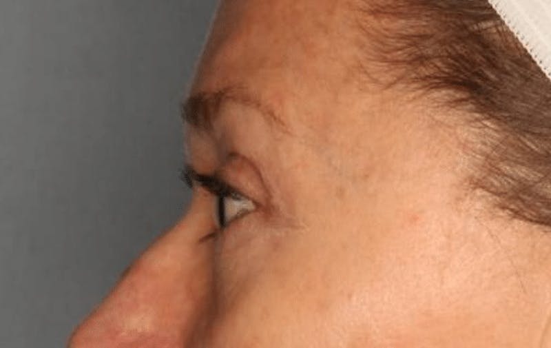 Blepharoplasty Before & After Gallery - Patient 55475010 - Image 6