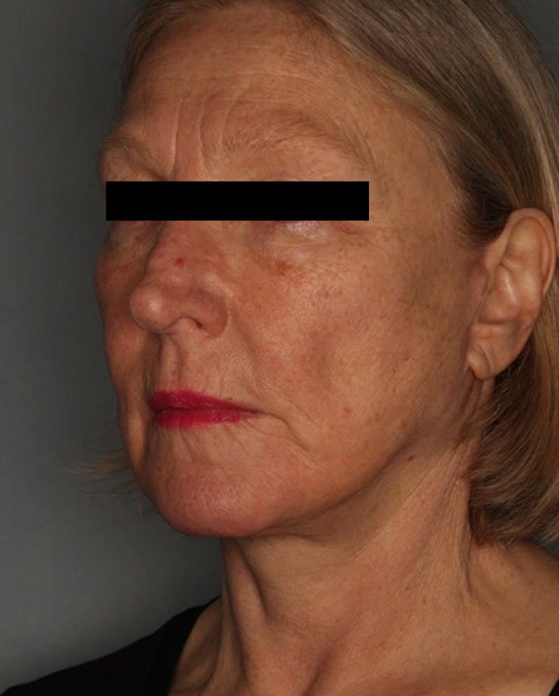 Facelift Before & After Gallery - Patient 55475009 - Image 8