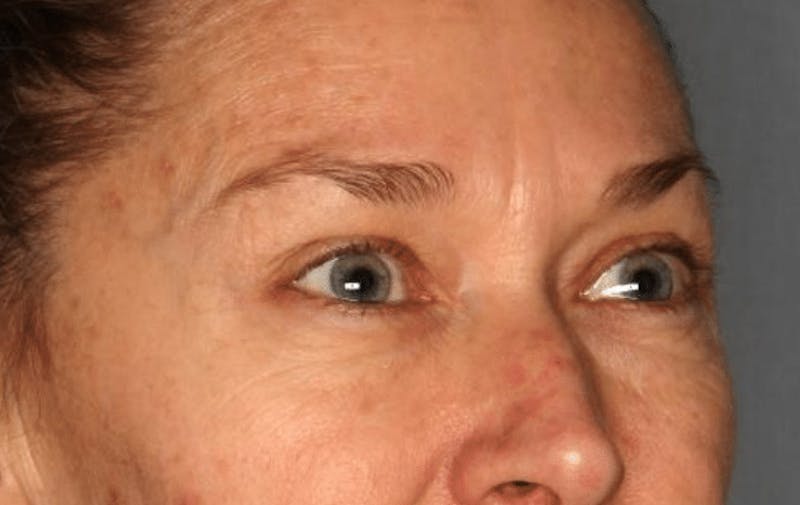 Blepharoplasty Before & After Gallery - Patient 55475010 - Image 7