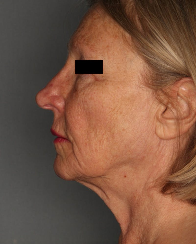 Facelift Before & After Gallery - Patient 55475009 - Image 9
