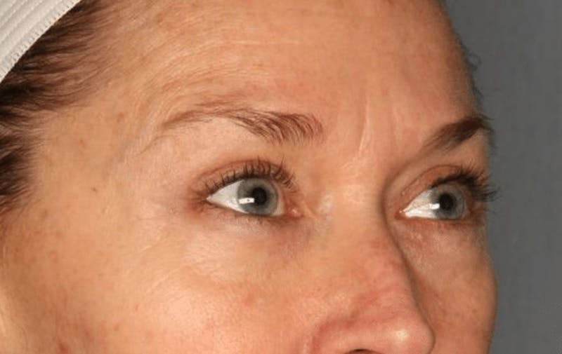 Blepharoplasty Before & After Gallery - Patient 55475010 - Image 8