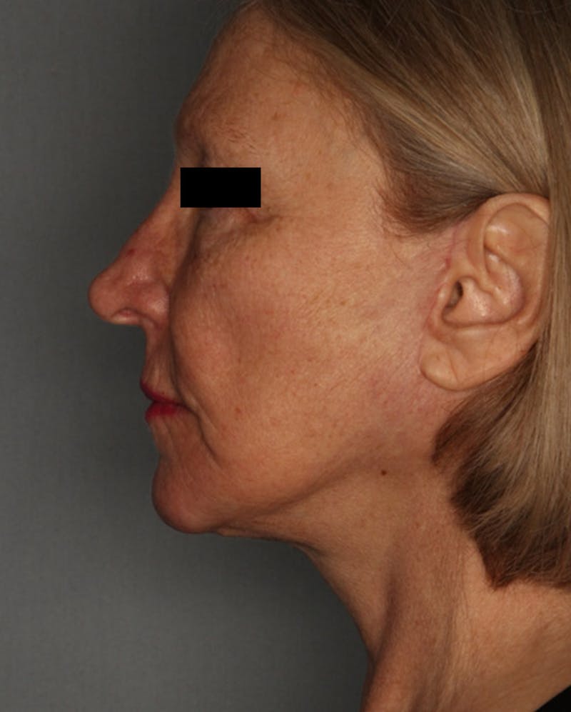 Facelift Before & After Gallery - Patient 55475009 - Image 10