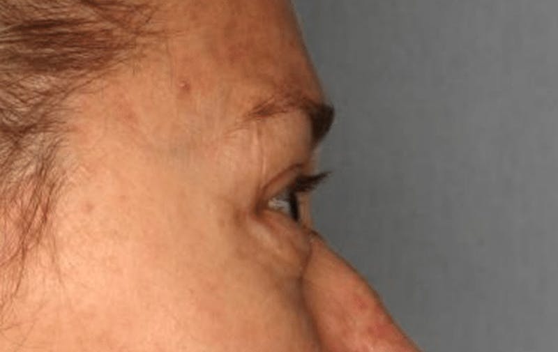 Blepharoplasty Before & After Gallery - Patient 55475010 - Image 9