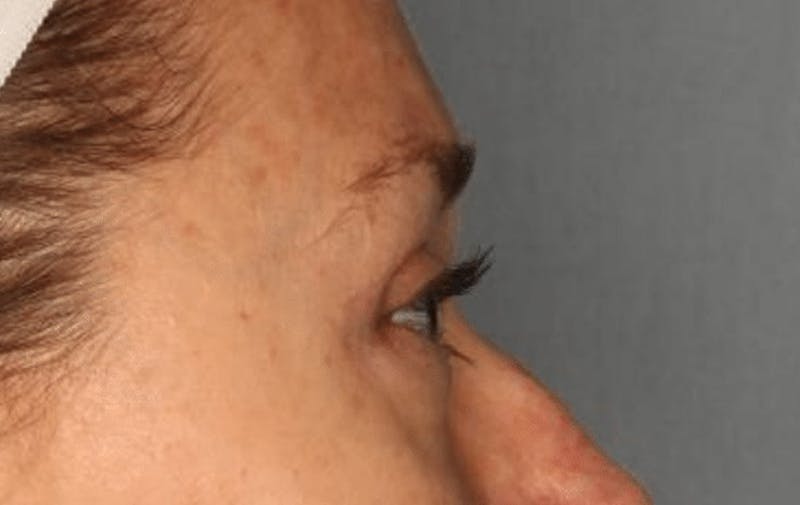 Blepharoplasty Before & After Gallery - Patient 55475010 - Image 10