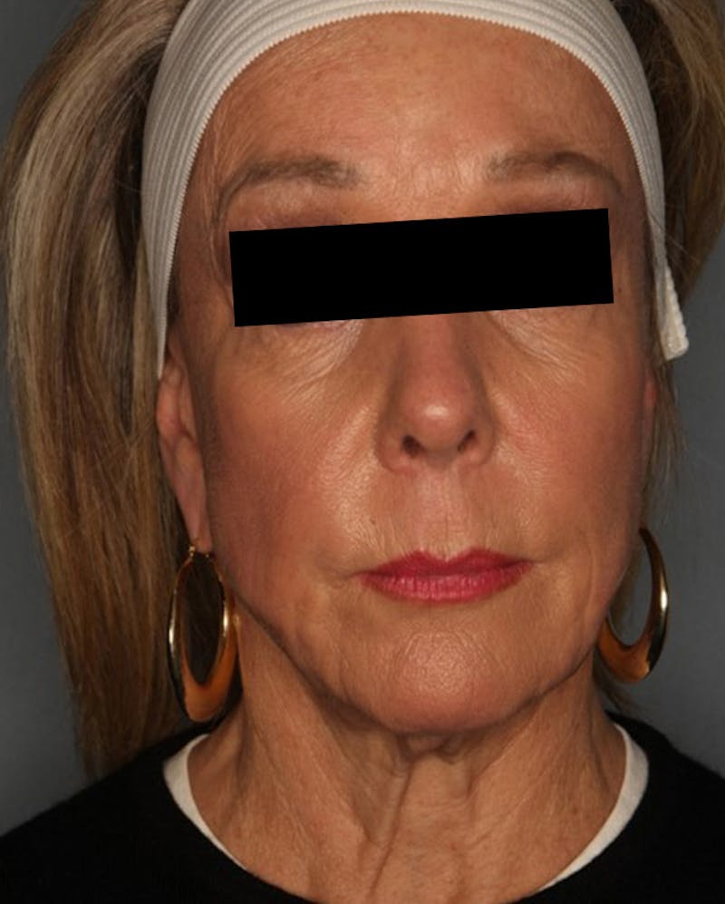 Facelift Before & After Gallery - Patient 55475011 - Image 1