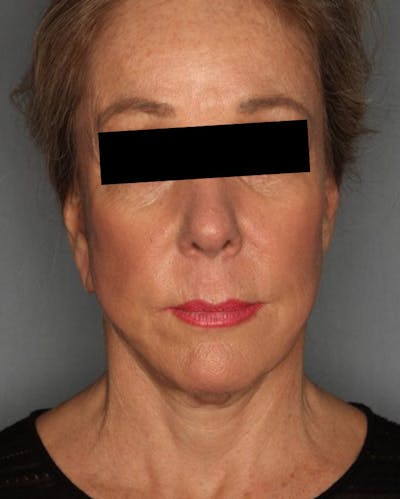 Facelift Before & After Gallery - Patient 55475011 - Image 2