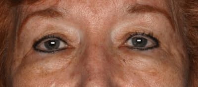 Blepharoplasty Before & After Gallery - Patient 55475012 - Image 1