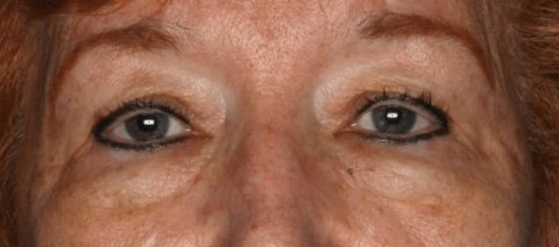 Blepharoplasty Before & After Gallery - Patient 55475012 - Image 1