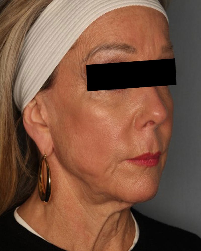 Facelift Before & After Gallery - Patient 55475011 - Image 3