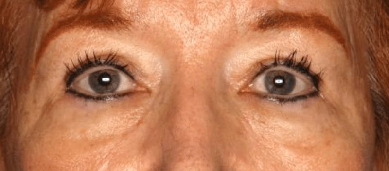 Blepharoplasty Before & After Gallery - Patient 55475012 - Image 2