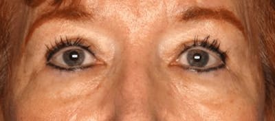 Blepharoplasty Before & After Gallery - Patient 55475012 - Image 2