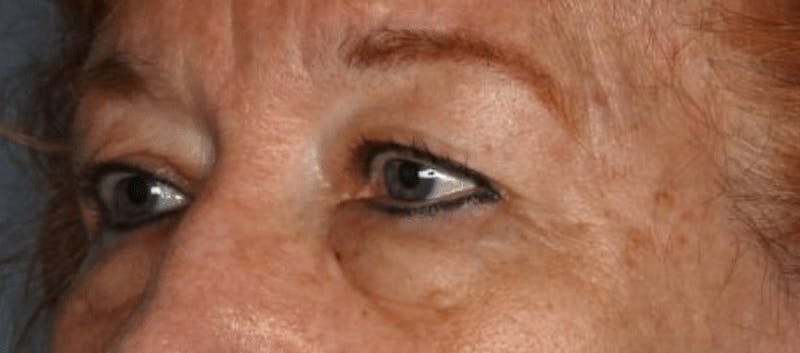 Blepharoplasty Before & After Gallery - Patient 55475012 - Image 3