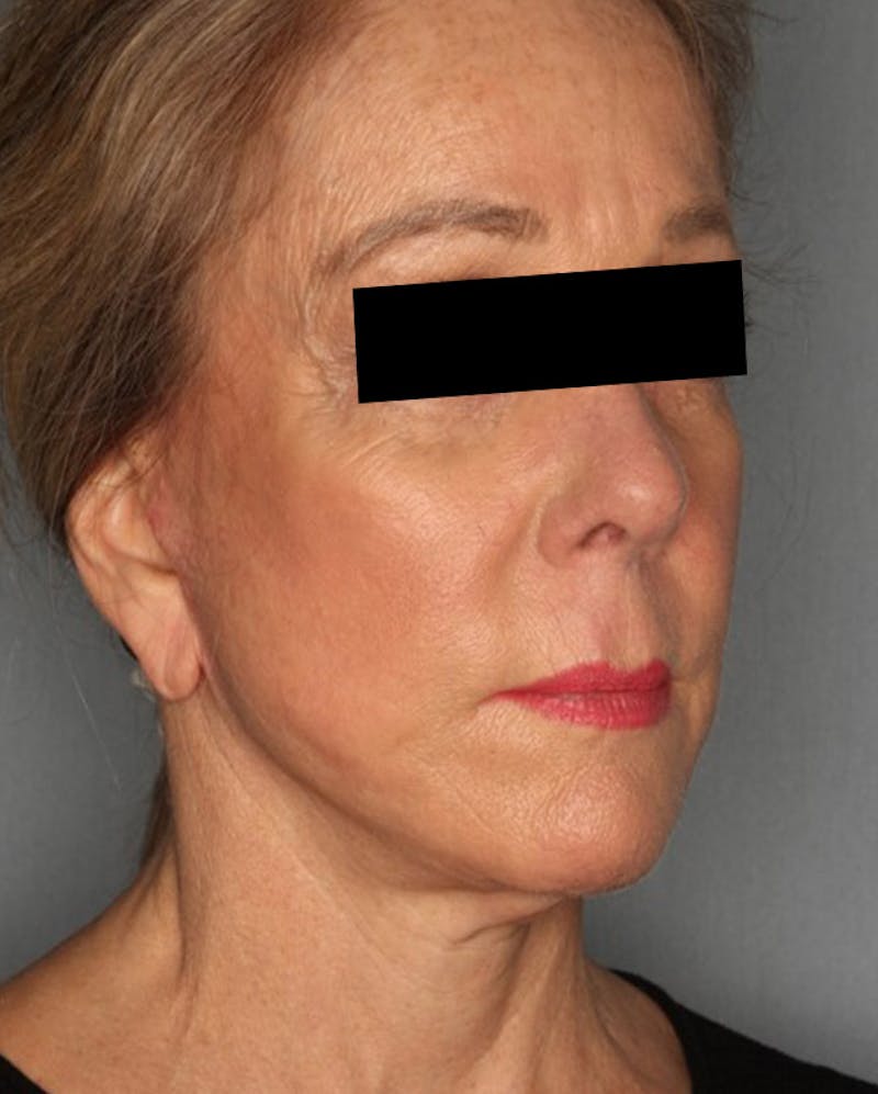 Facelift Before & After Gallery - Patient 55475011 - Image 4