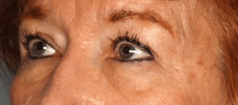 Blepharoplasty Before & After Gallery - Patient 55475012 - Image 4