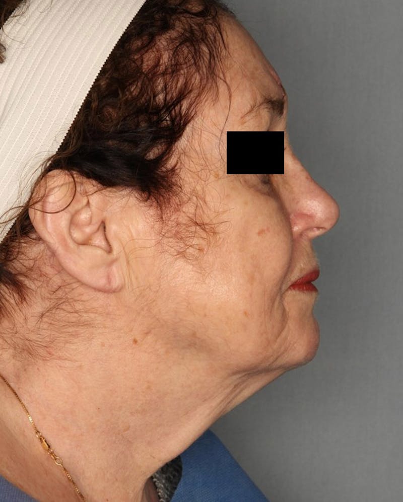 Facelift Before & After Gallery - Patient 55475014 - Image 1