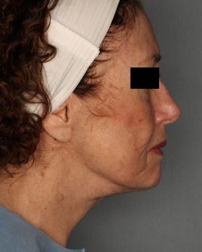 Facelift Before & After Gallery - Patient 55475014 - Image 2
