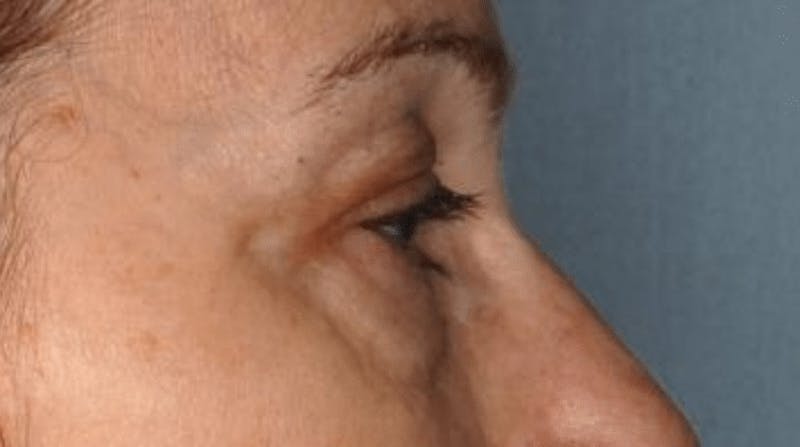 Blepharoplasty Before & After Gallery - Patient 55475013 - Image 1