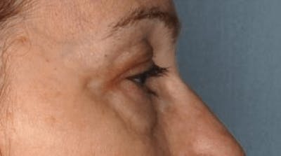 Blepharoplasty Before & After Gallery - Patient 55475013 - Image 1