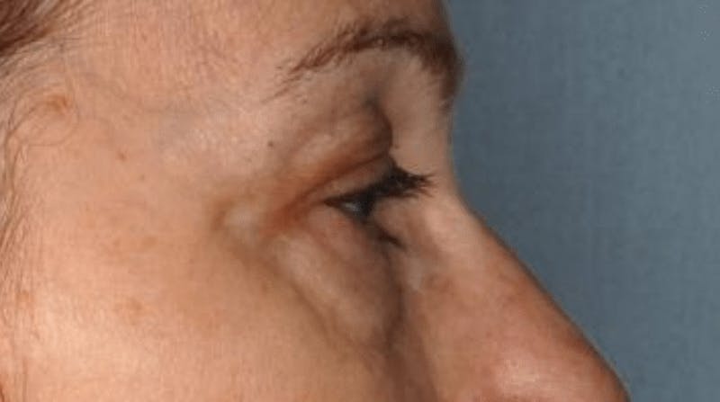 Blepharoplasty Before & After Gallery - Patient 55475013 - Image 1