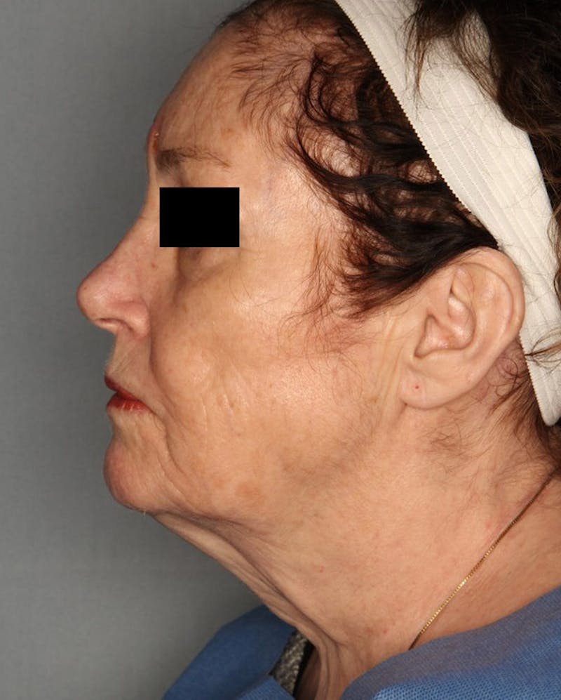 Facelift Before & After Gallery - Patient 55475014 - Image 3