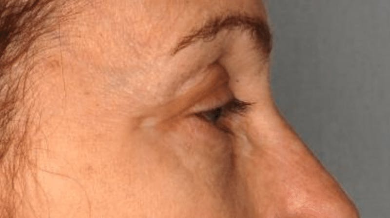 Blepharoplasty Before & After Gallery - Patient 55475013 - Image 2