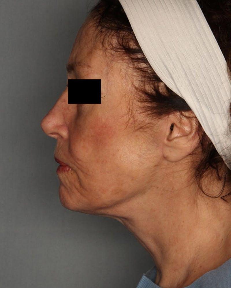 Facelift Before & After Gallery - Patient 55475014 - Image 4