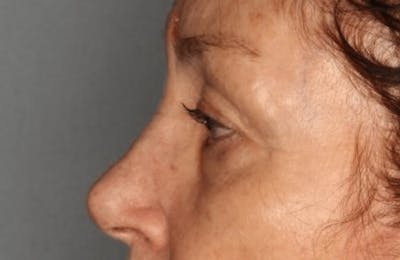 Blepharoplasty Before & After Gallery - Patient 55475015 - Image 1