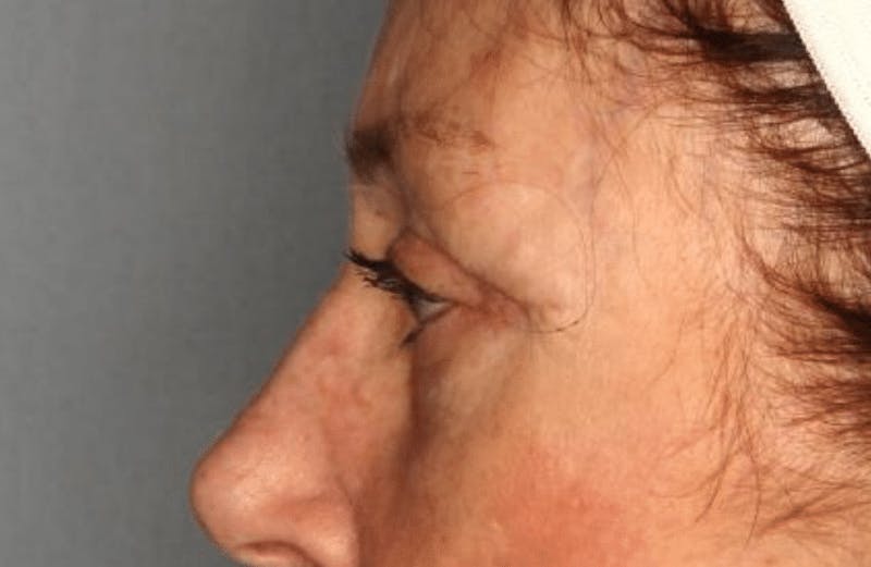 Blepharoplasty Before & After Gallery - Patient 55475015 - Image 2