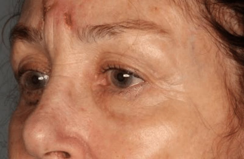 Blepharoplasty Before & After Gallery - Patient 55475015 - Image 3