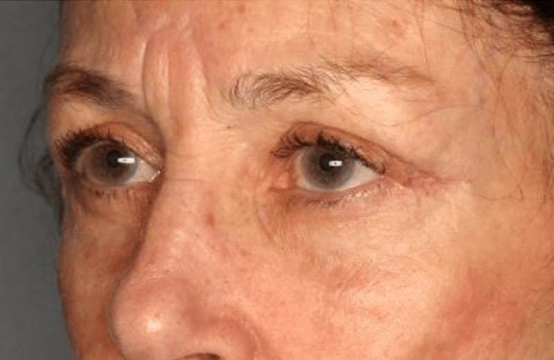 Blepharoplasty Before & After Gallery - Patient 55475015 - Image 4