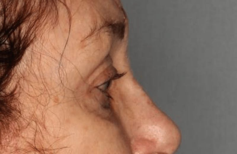 Blepharoplasty Before & After Gallery - Patient 55475015 - Image 5