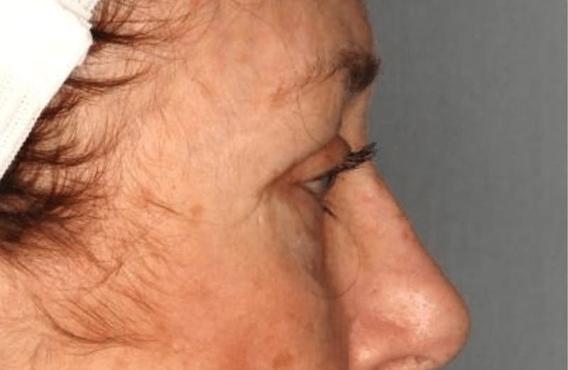 Blepharoplasty Before & After Gallery - Patient 55475015 - Image 6