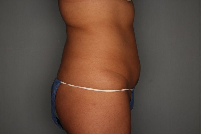 CoolSculpting Before & After Gallery - Patient 55475018 - Image 1