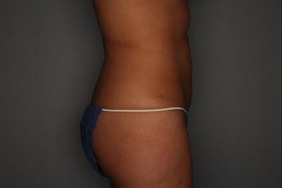 CoolSculpting Before & After Gallery - Patient 55475018 - Image 2