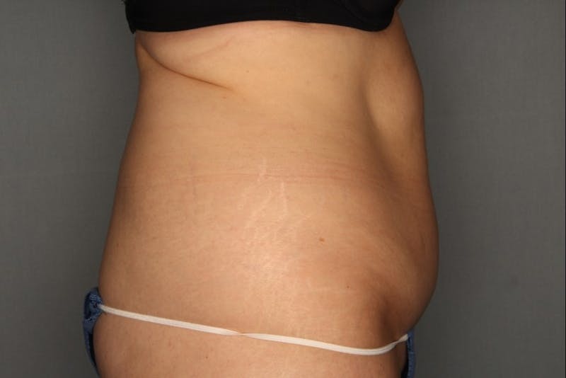 CoolSculpting Before & After Gallery - Patient 55475019 - Image 1