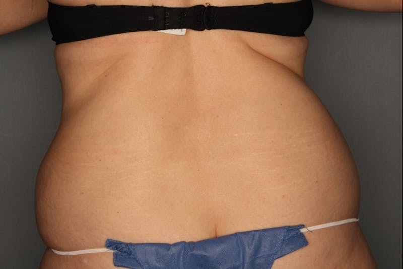 CoolSculpting Before & After Gallery - Patient 55475019 - Image 3