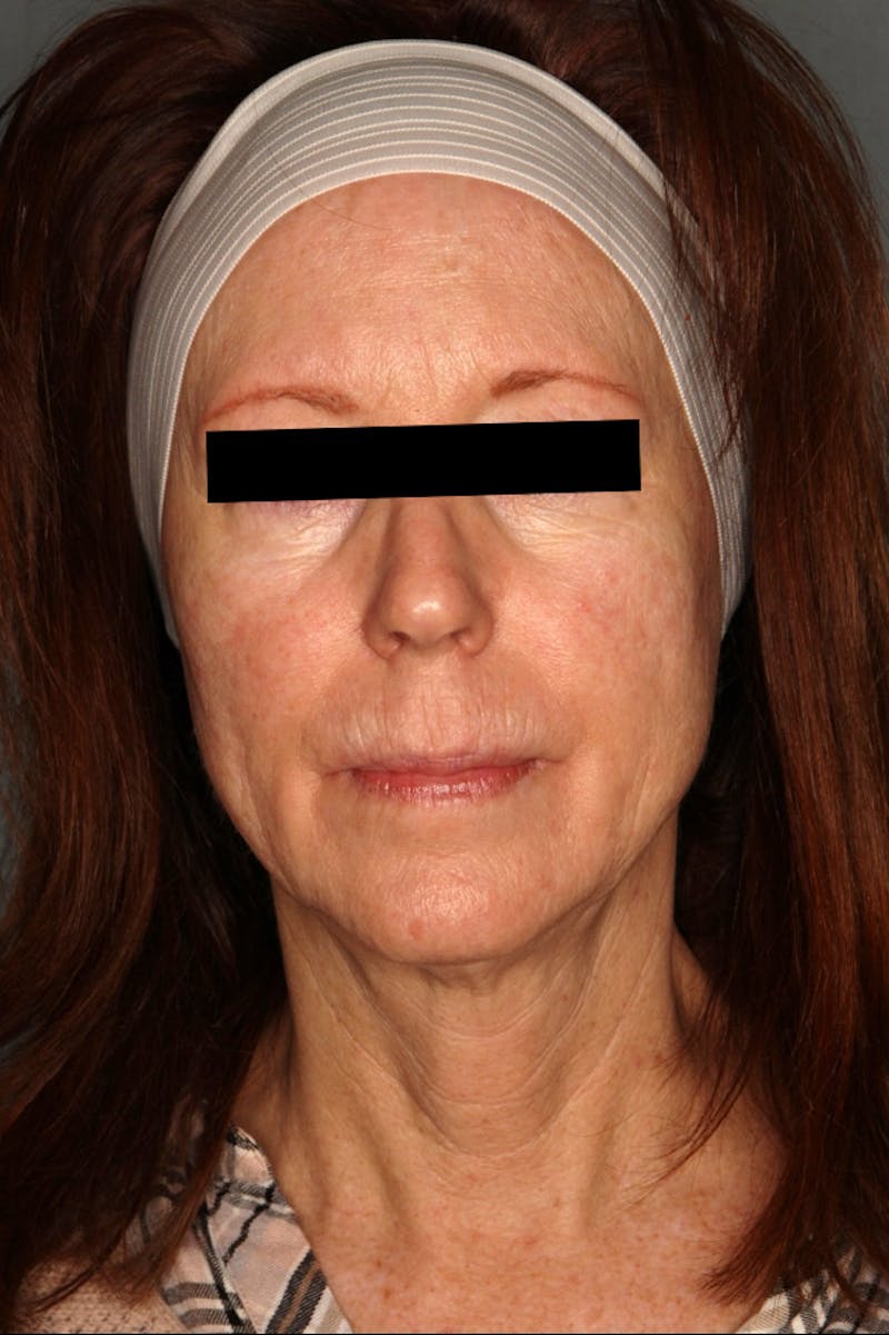 Halo Laser Before & After Gallery - Patient 55475022 - Image 1