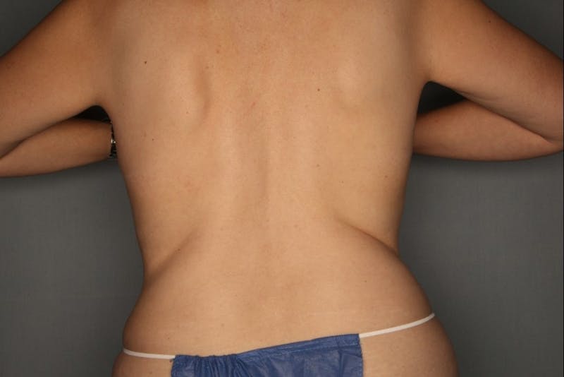 CoolSculpting Before & After Gallery - Patient 55475019 - Image 4