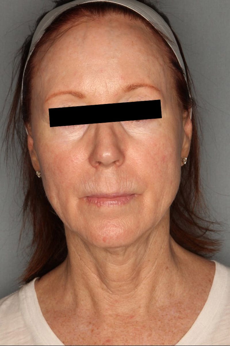 Halo Laser Before & After Gallery - Patient 55475022 - Image 2