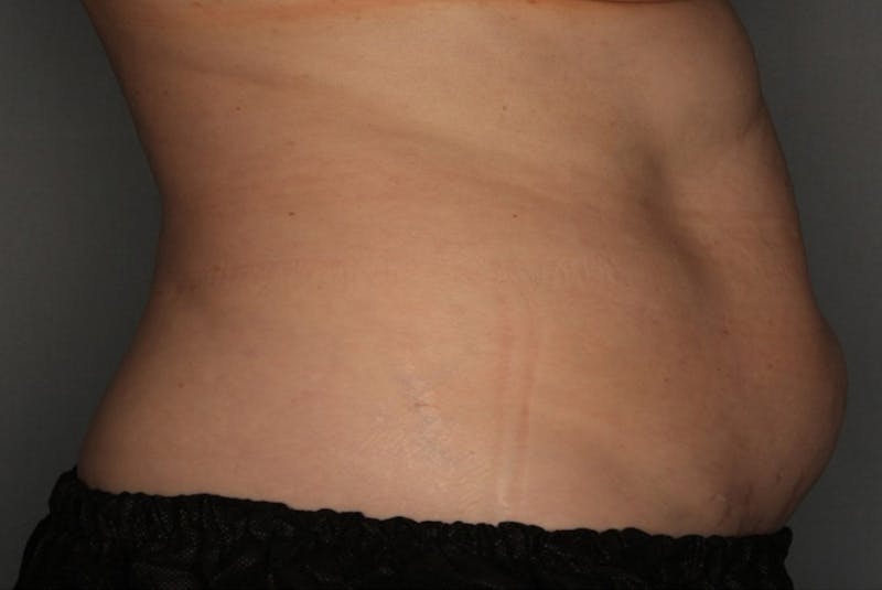 CoolSculpting Before & After Gallery - Patient 55475020 - Image 1