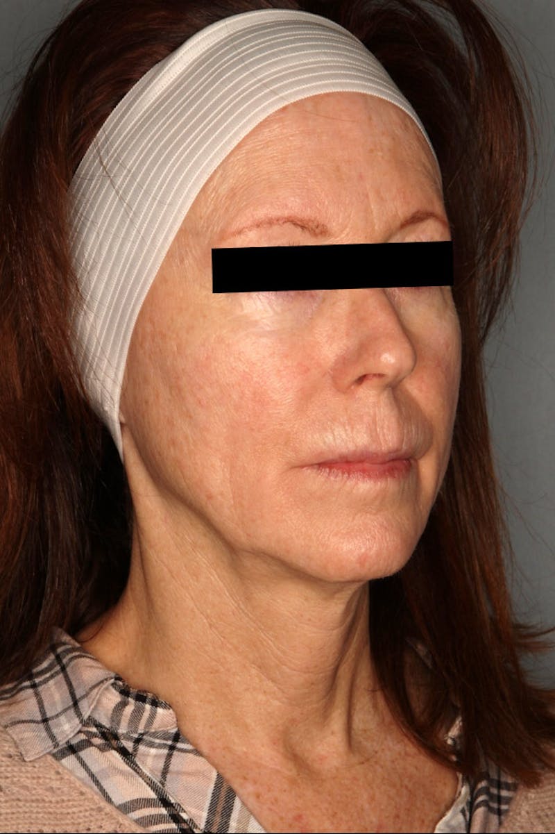 Halo Laser Before & After Gallery - Patient 55475022 - Image 3